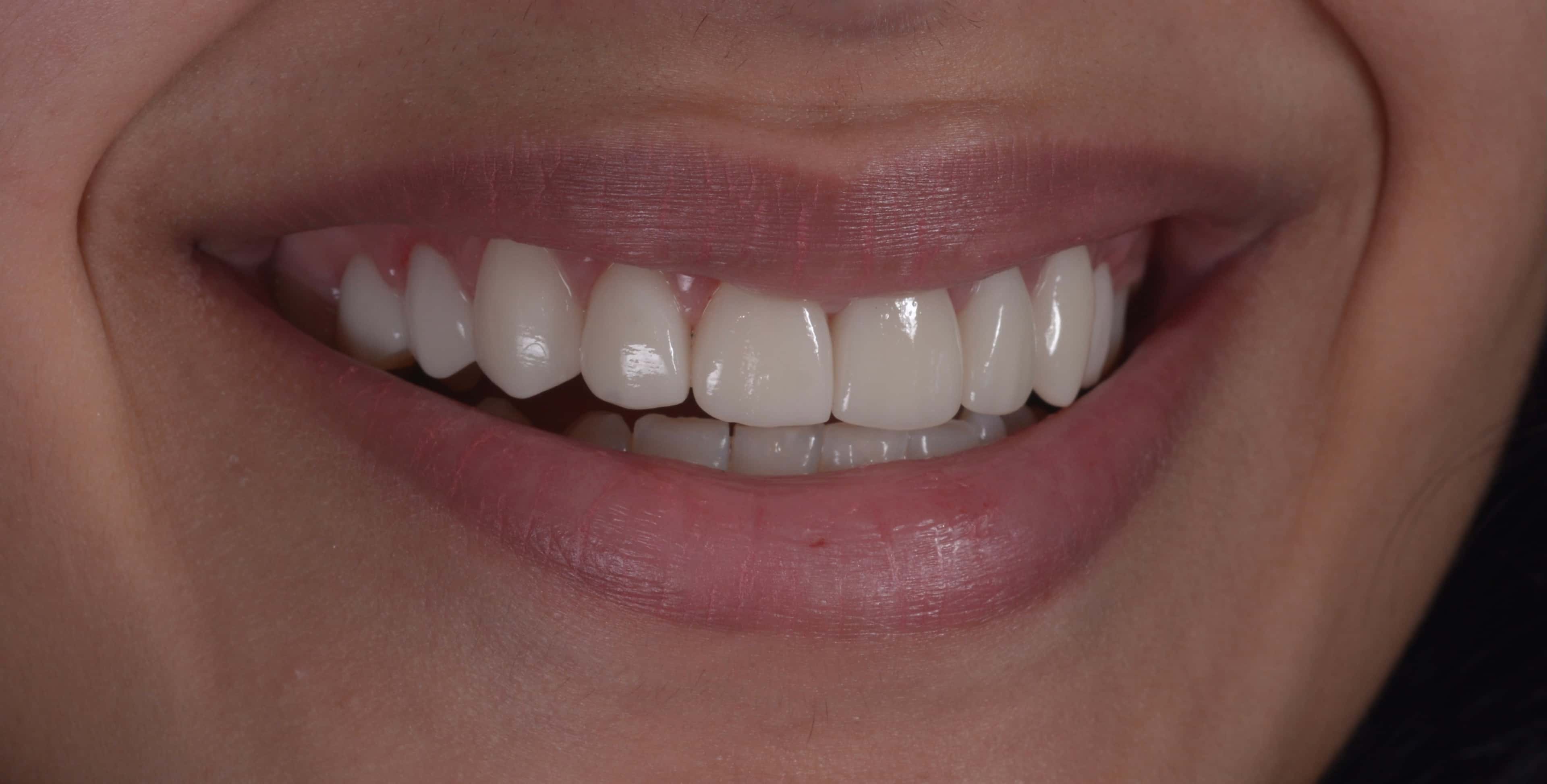 Dental transformation after treatment at Beyond Smiles Dental Clinic
