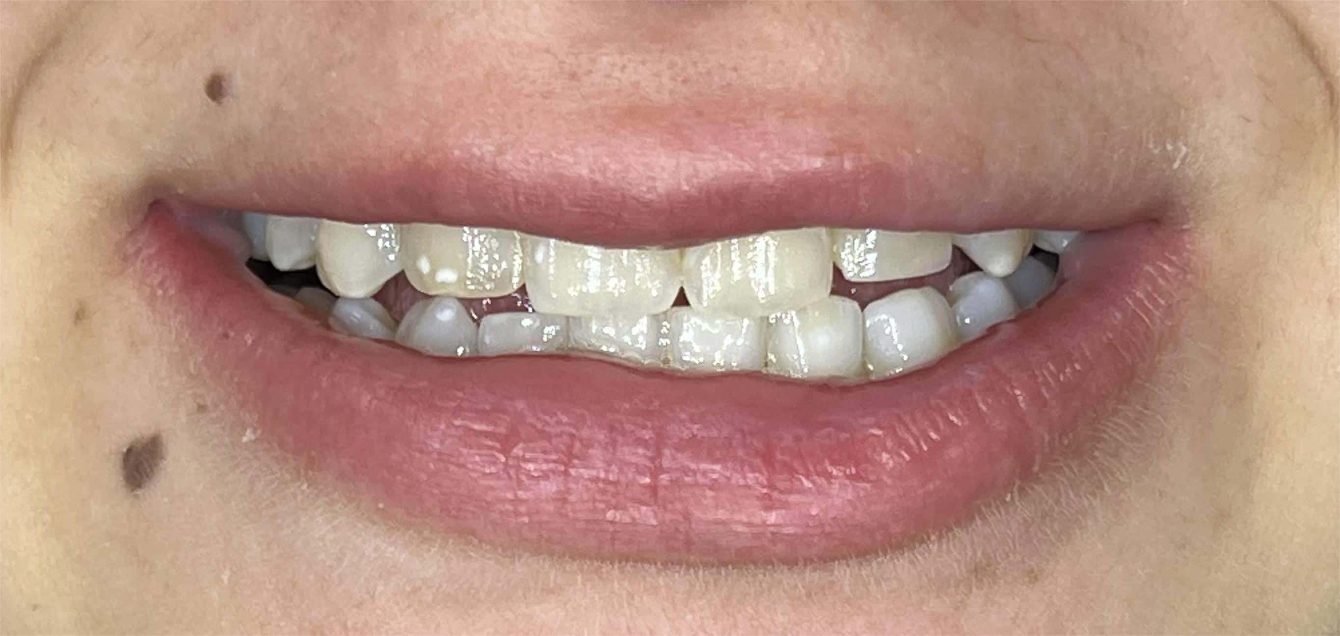 Dental transformation before treatment at Beyond Smiles Dental Clinic