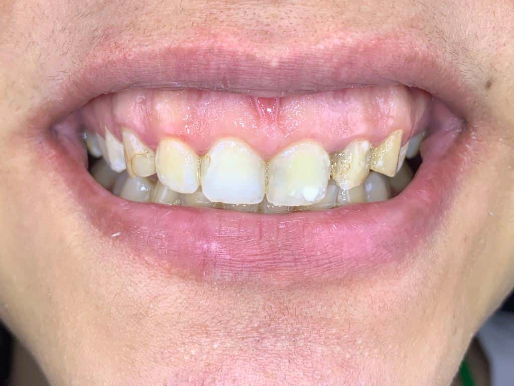 Dental transformation before treatment at Beyond Smiles Dental Clinic