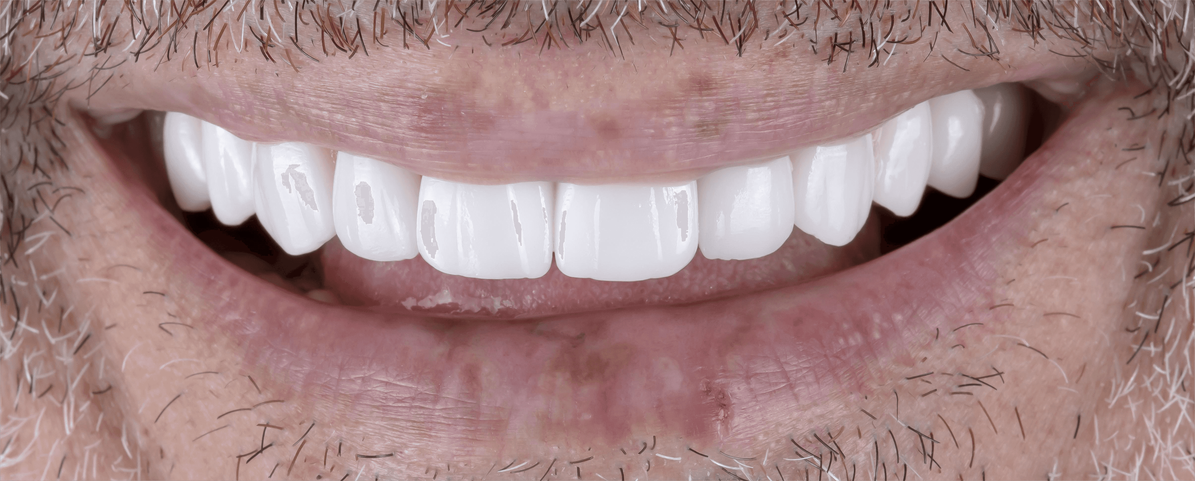 Dental transformation after treatment at Beyond Smiles Dental Clinic