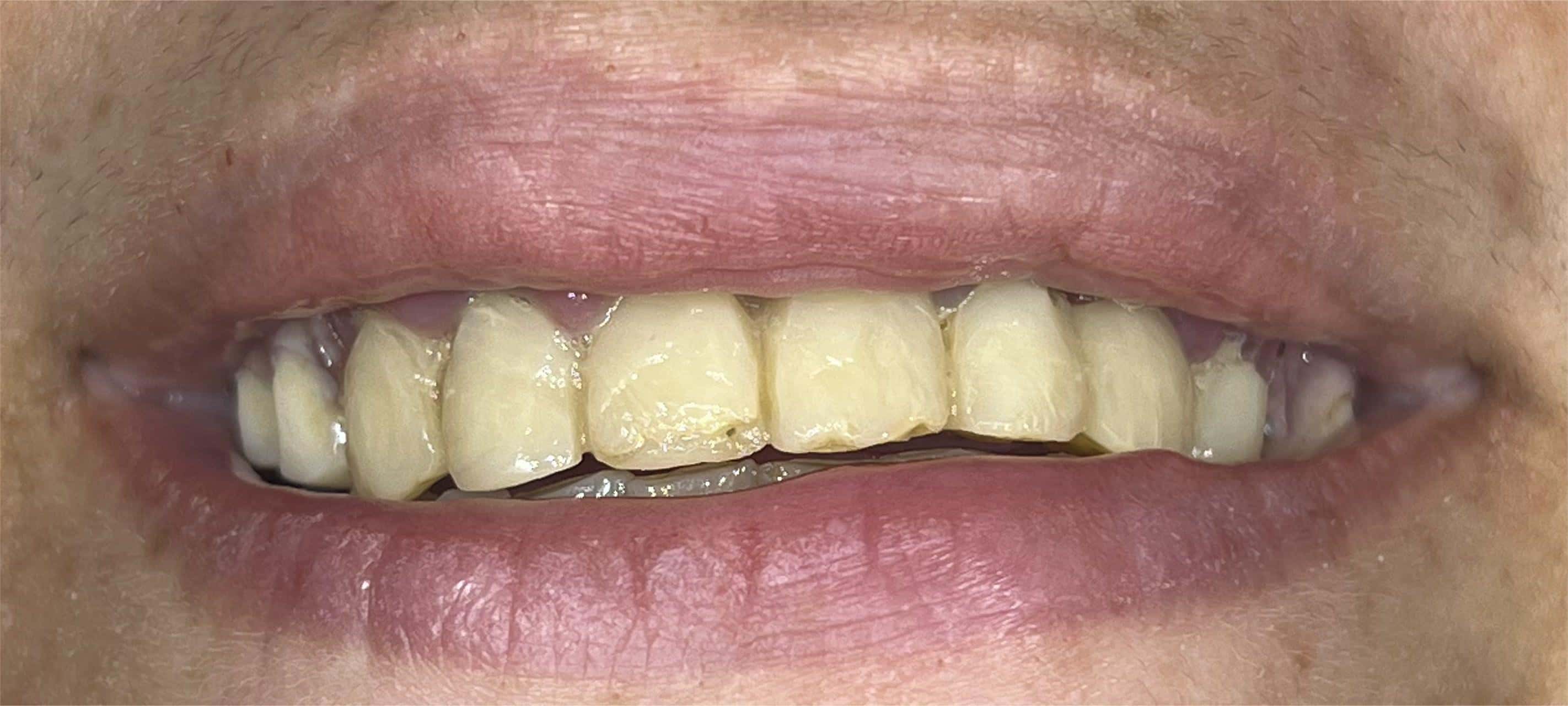 Dental transformation before treatment at Beyond Smiles Dental Clinic