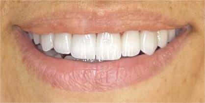 Dental transformation after treatment at Beyond Smiles Dental Clinic