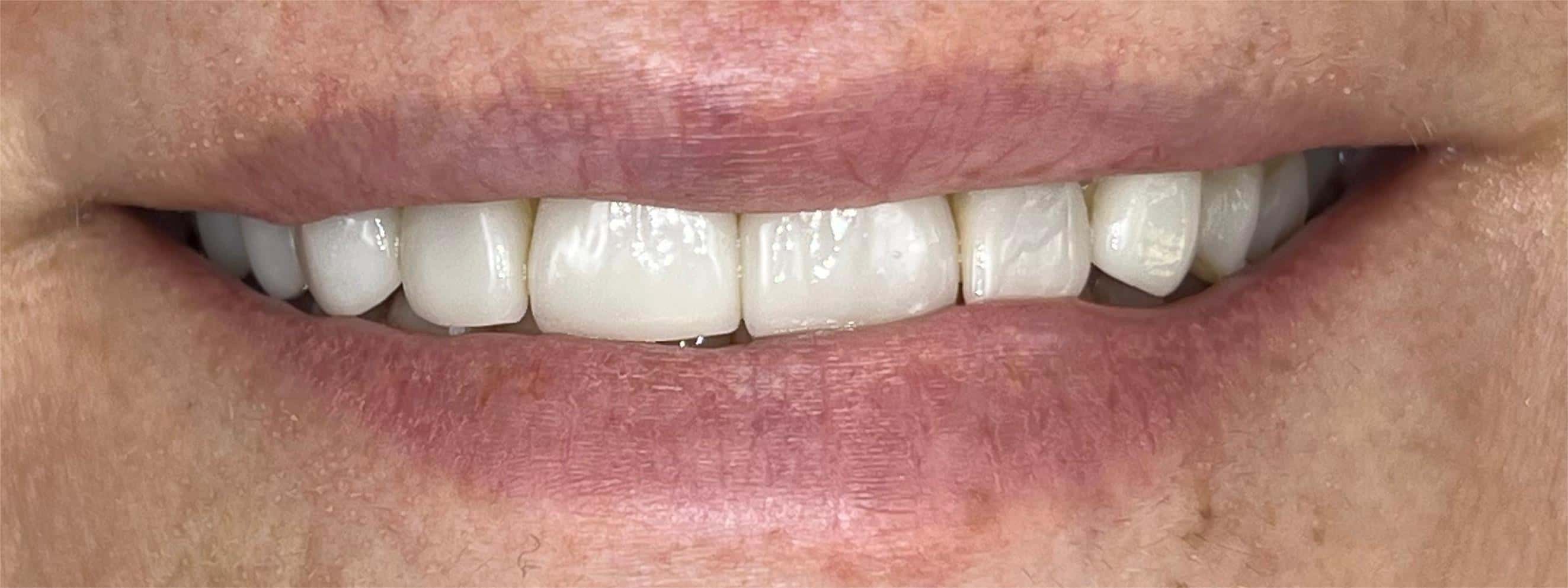 Dental transformation before treatment at Beyond Smiles Dental Clinic