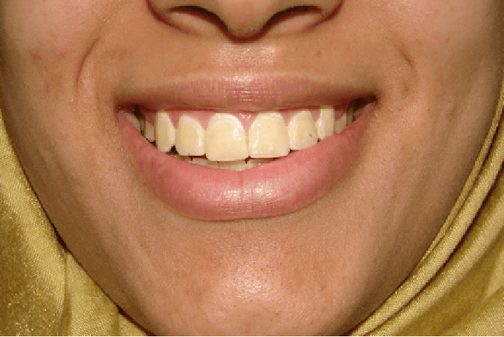 Dental transformation after treatment at Beyond Smiles Dental Clinic
