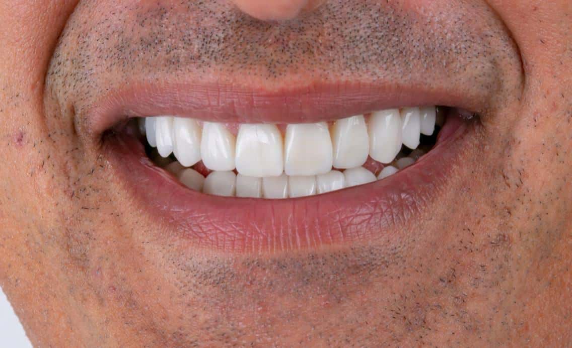 Dental transformation after treatment at Beyond Smiles Dental Clinic