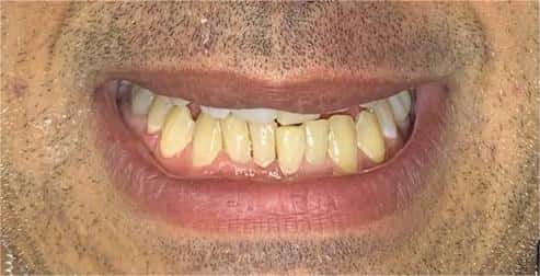 Dental transformation before treatment at Beyond Smiles Dental Clinic